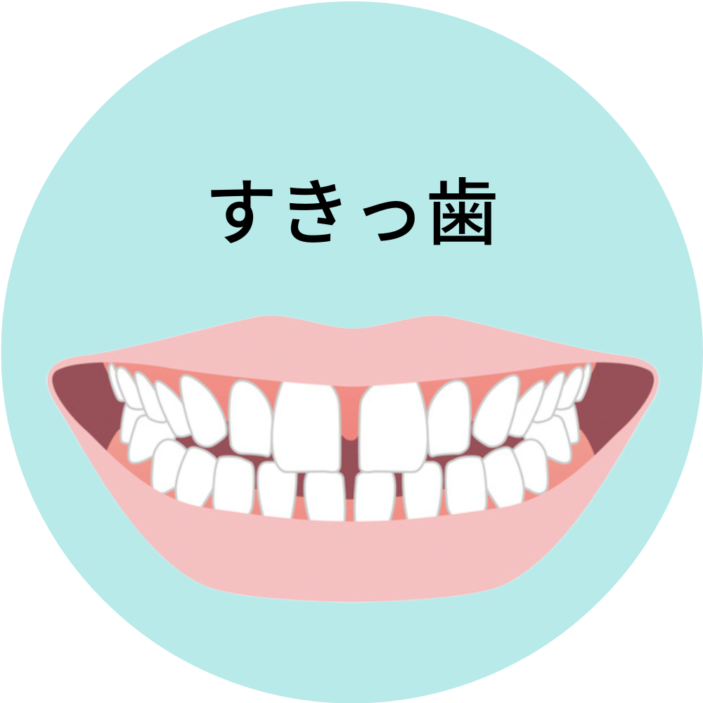 沖縄県那覇市で人気の安いおすすめのすきっ歯の歯列矯正