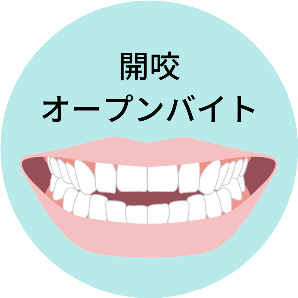 沖縄県那覇市で人気の安いおすすめの開咬・オープンバイトの歯列矯正