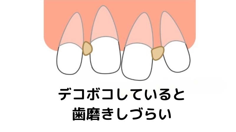 デコボコしていると歯磨きしづらい