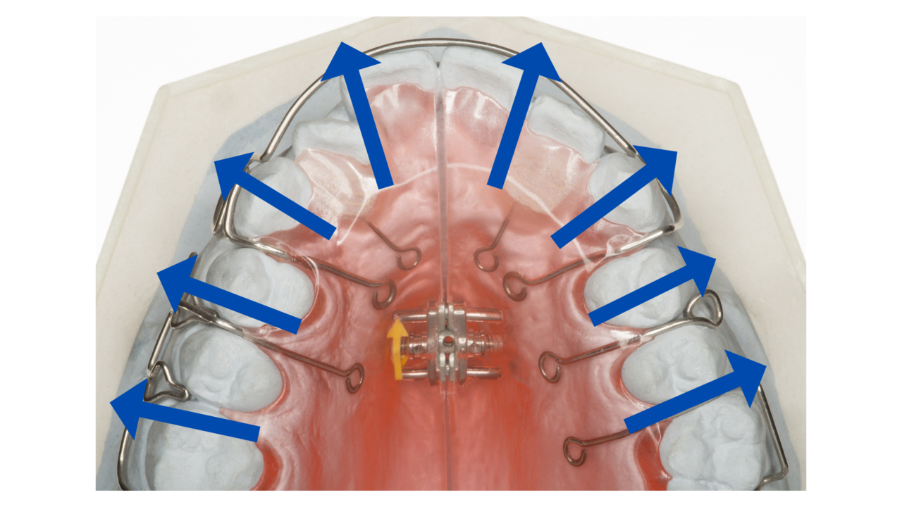 拡大床をやりすぎた
