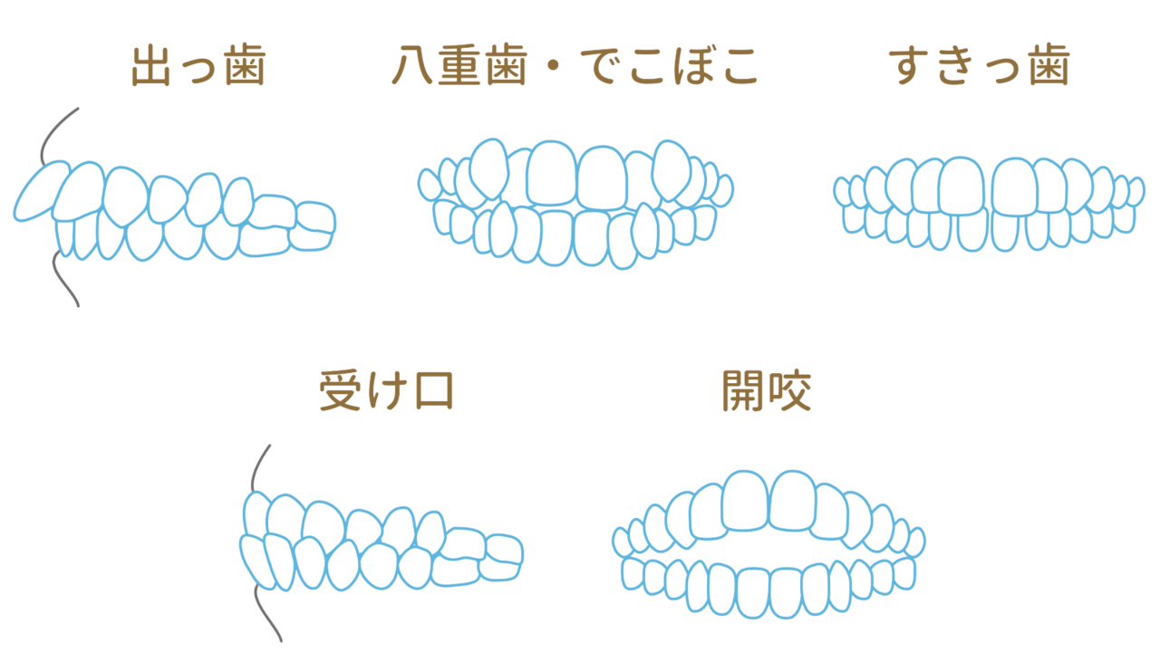 インビザラインができない 症例でもお任せください