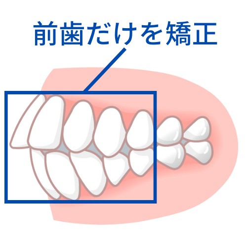 前歯だけを動かす矯正で失敗 - 沖縄那覇矯正歯科相談室