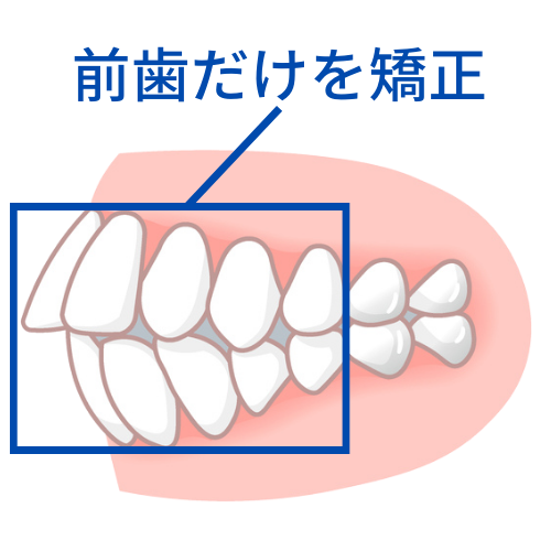前歯だけを動かす矯正で失敗 - 沖縄那覇矯正歯科相談室