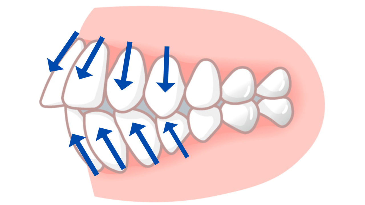 非抜歯で無理やり矯正をした