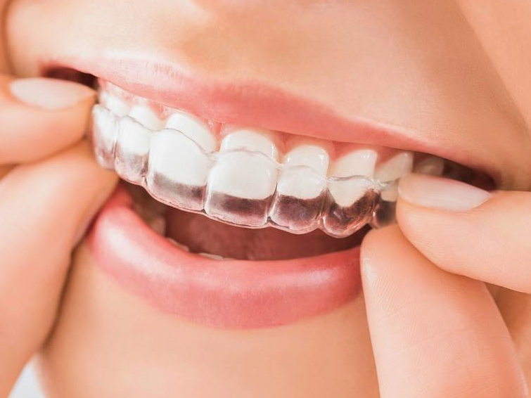 透明で目立たないマウスピース矯正 - 沖縄県那覇市 矯正歯科相談室