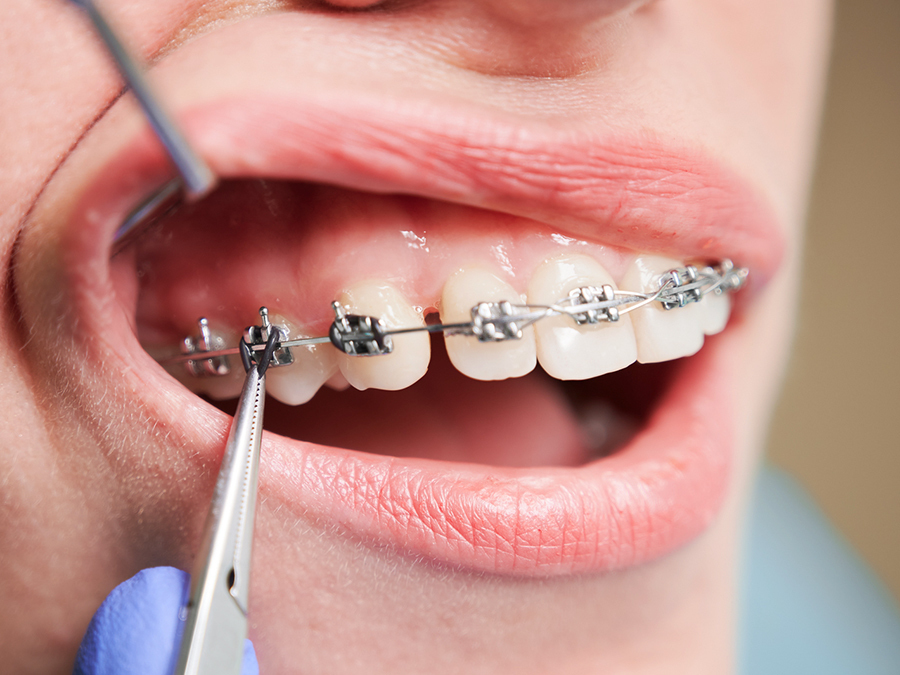 従来のワイヤー矯正 - 沖縄県那覇市 矯正歯科相談室