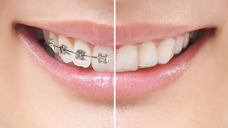 マウスピース矯正は目立たない - 沖縄県那覇市 矯正歯科相談室