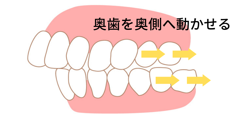 インビザラインは奥歯を動かせる - 沖縄那覇矯正歯科相談室
