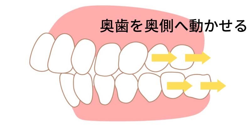 インビザラインは奥歯を動かせる - 沖縄那覇矯正歯科相談室