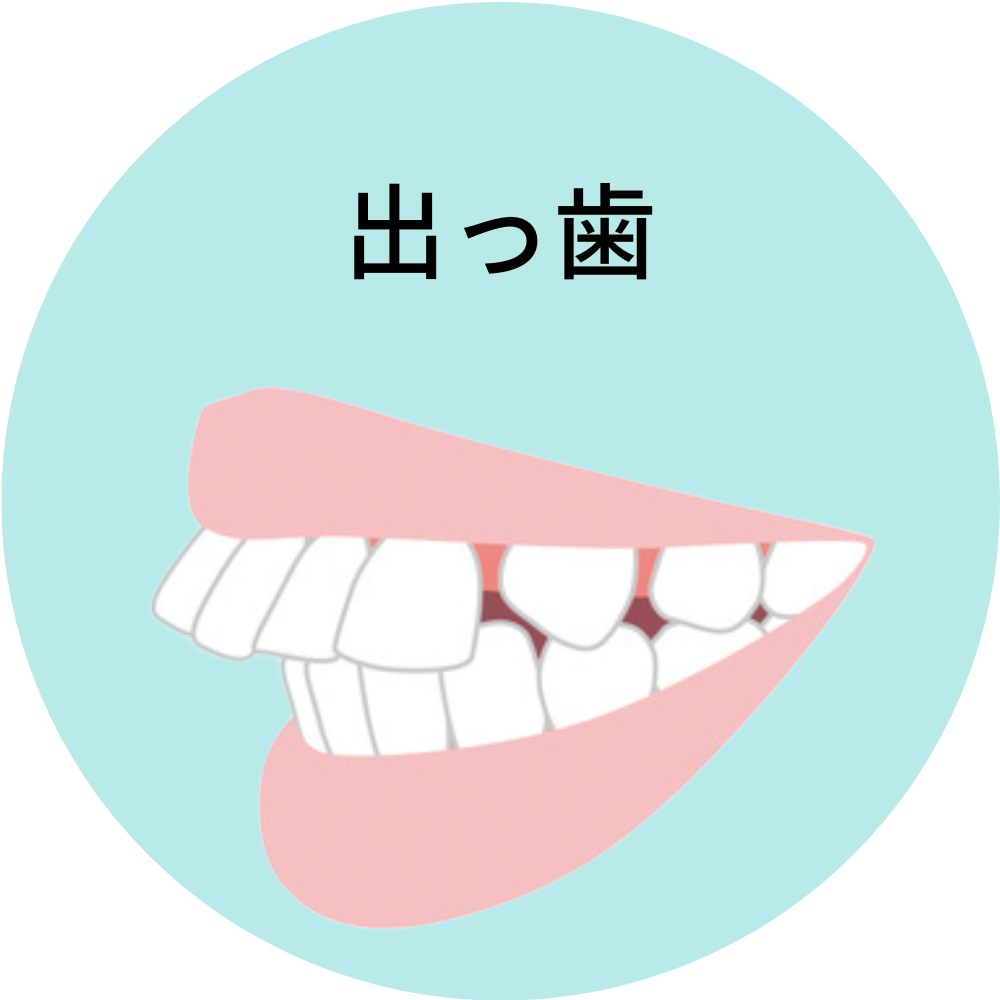 沖縄県那覇市で人気の安いおすすめの出っ歯・上顎前突の歯列矯正